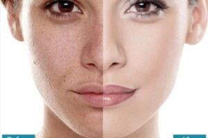 5 SERUM WAJAH TERBAIK UNTUK MENYEMBUHKAN JERAWAT